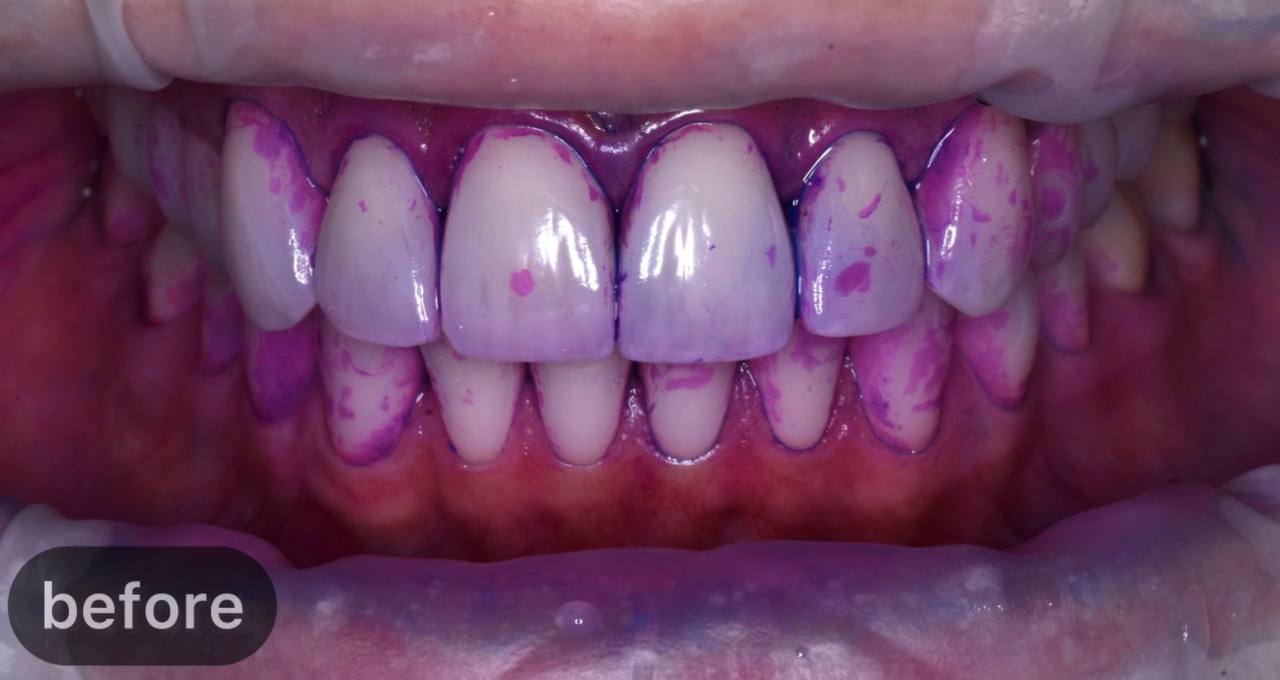 dental hygiene
