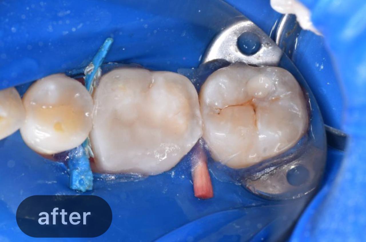 Root canal treatment