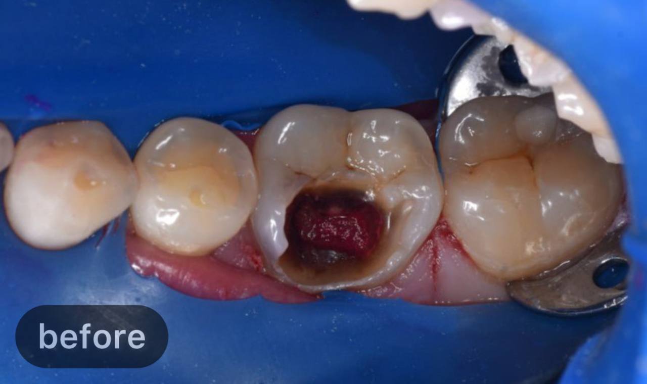 Root canal treatment