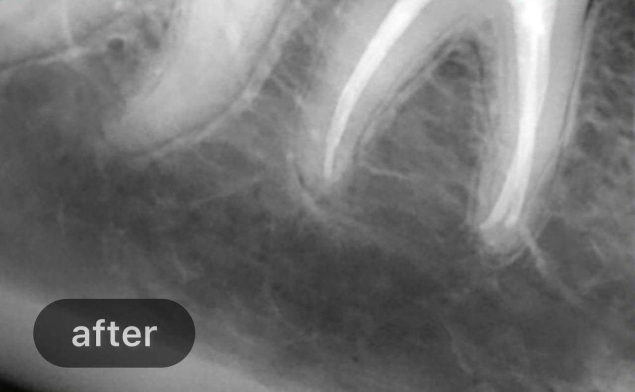 Root canal treatment