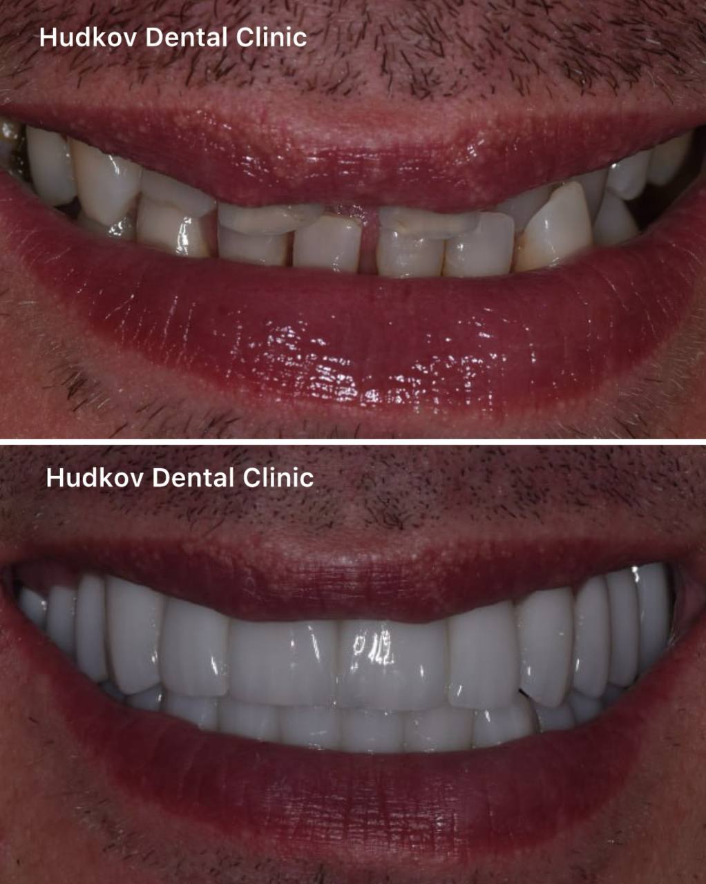 Leczenie endodontyczne