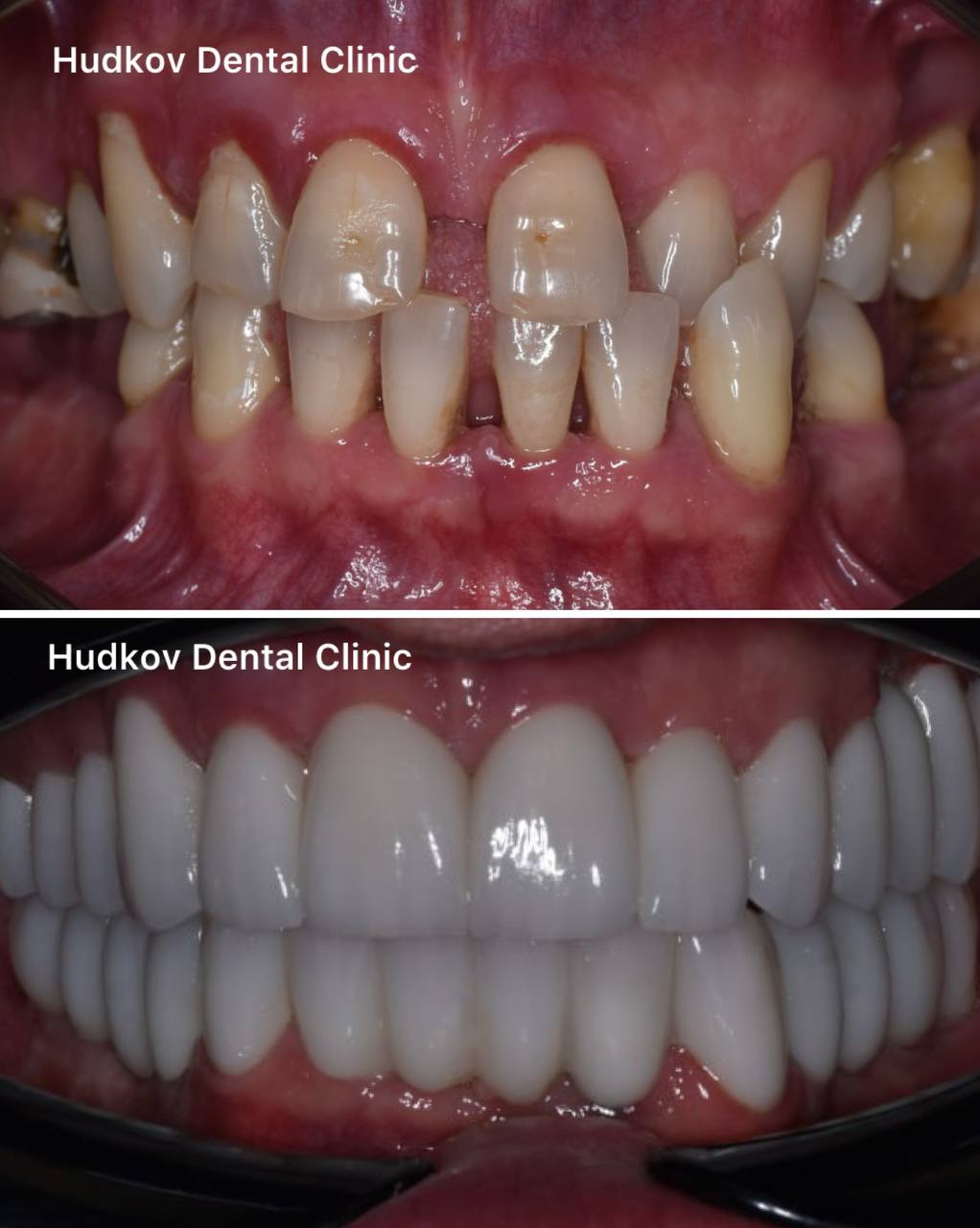 Leczenie endodontyczne