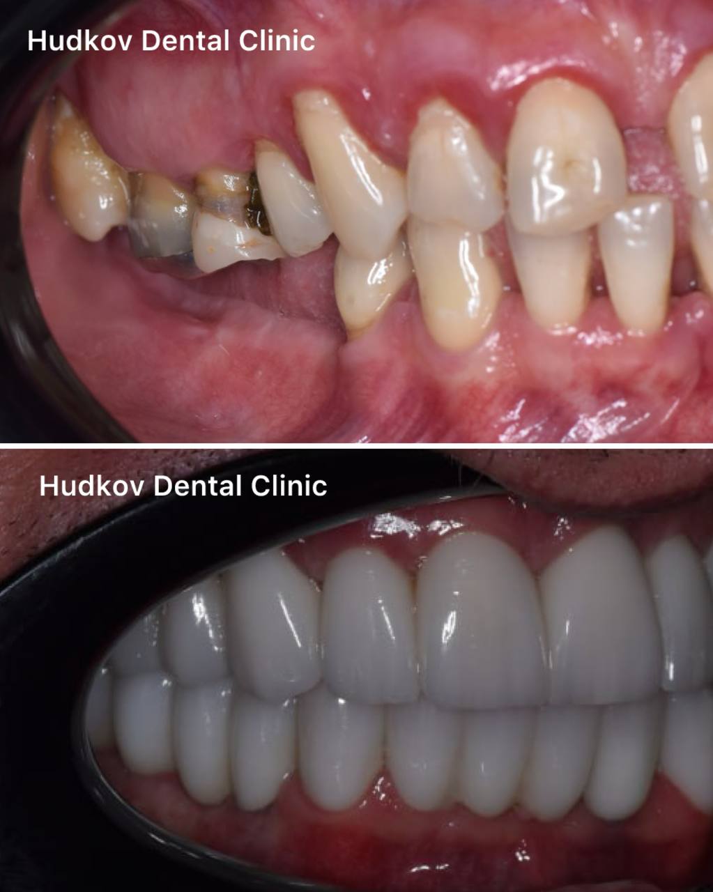 Leczenie endodontyczne