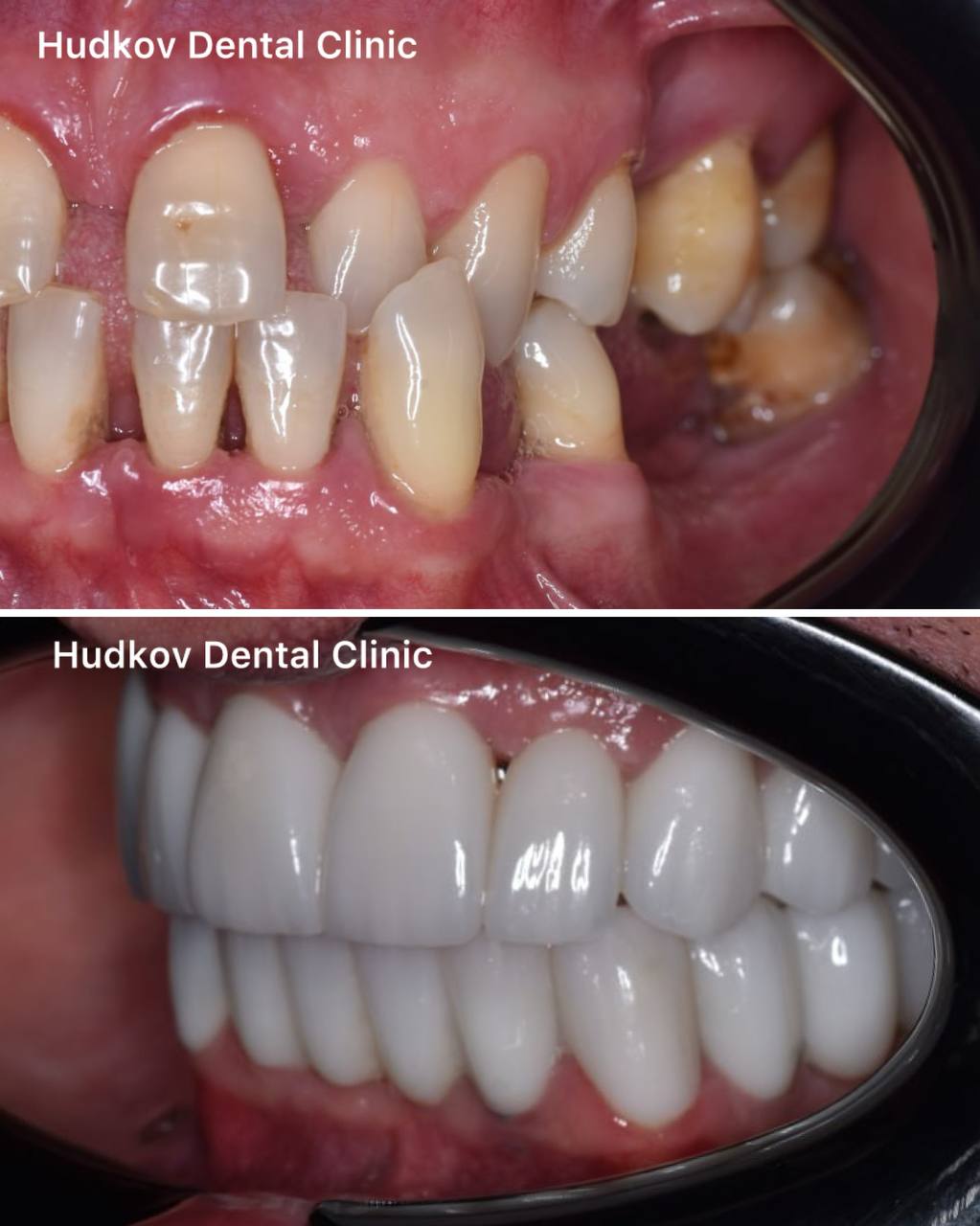 Leczenie endodontyczne